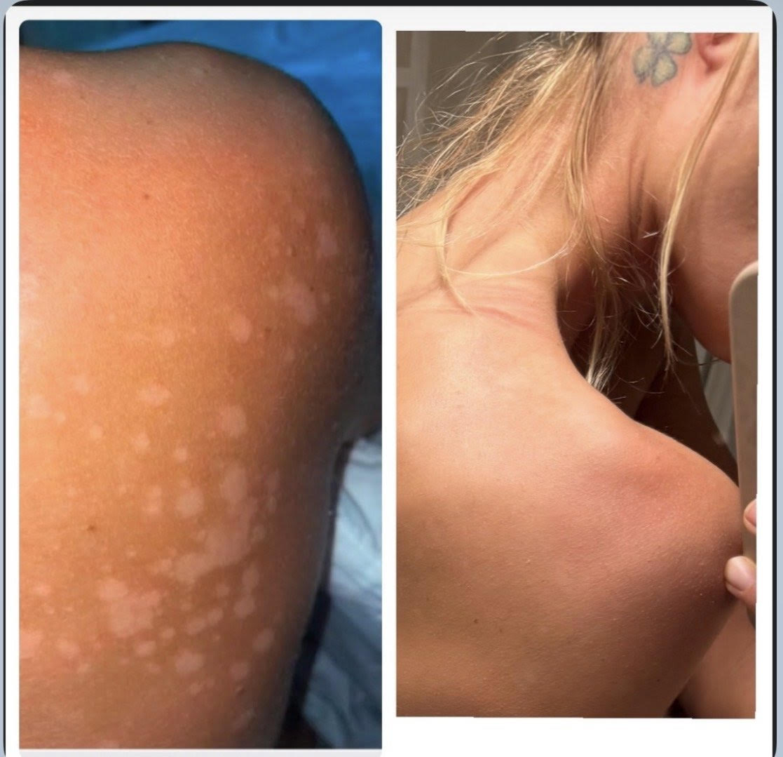 Autoimmune and gut transformation